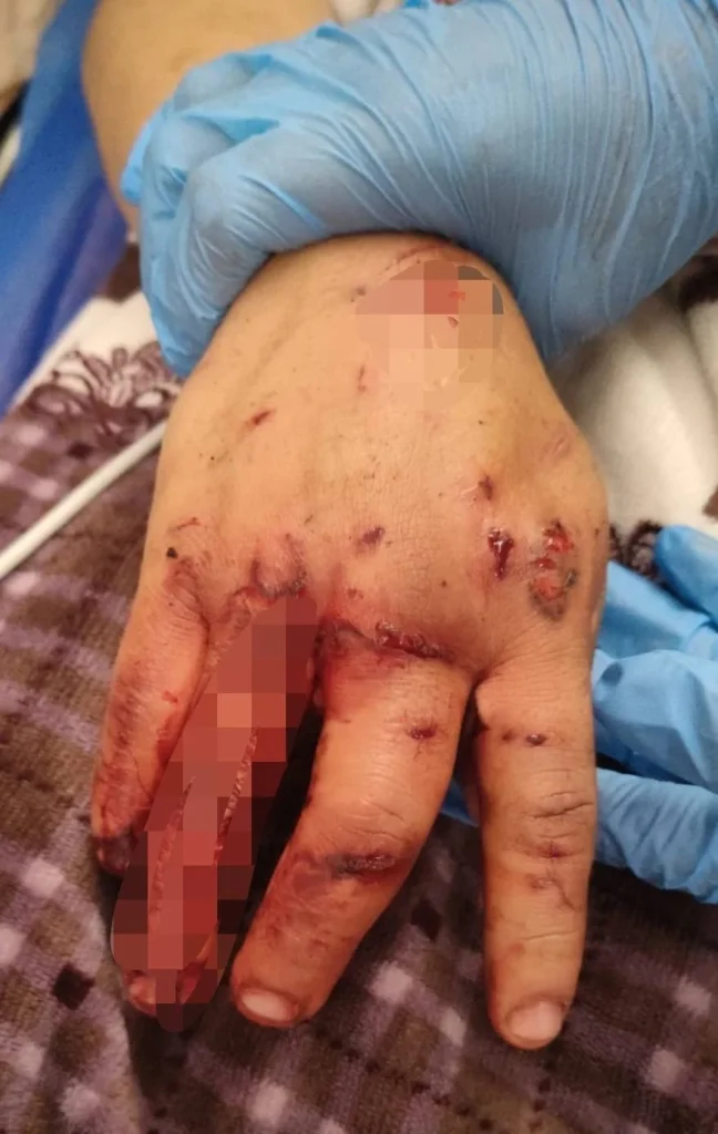 La mano de Jesús Belisario requirió atención urgente en Riobamba