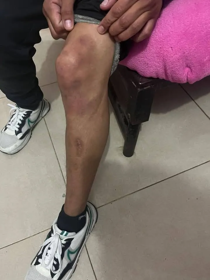 Golpes que reportaron las víctimas.