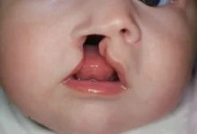 Cirugías de labio leporino gratis en Latacunga cómo acceder.