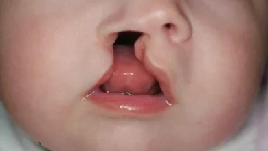 Cirugías de labio leporino gratis en Latacunga cómo acceder.