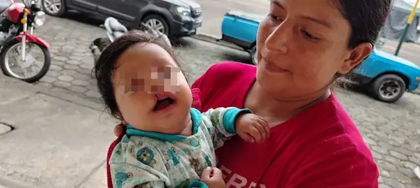 Madre busca ayuda para cirugía de su bebé con labio leporino